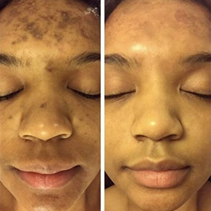 Natural Spots Free Serum
