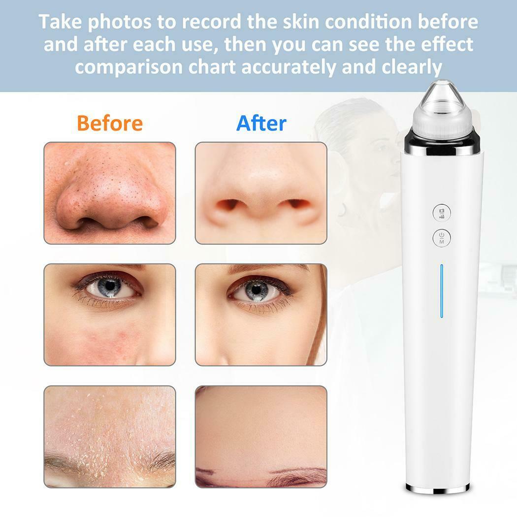 Blackhead Remover with a HD camera