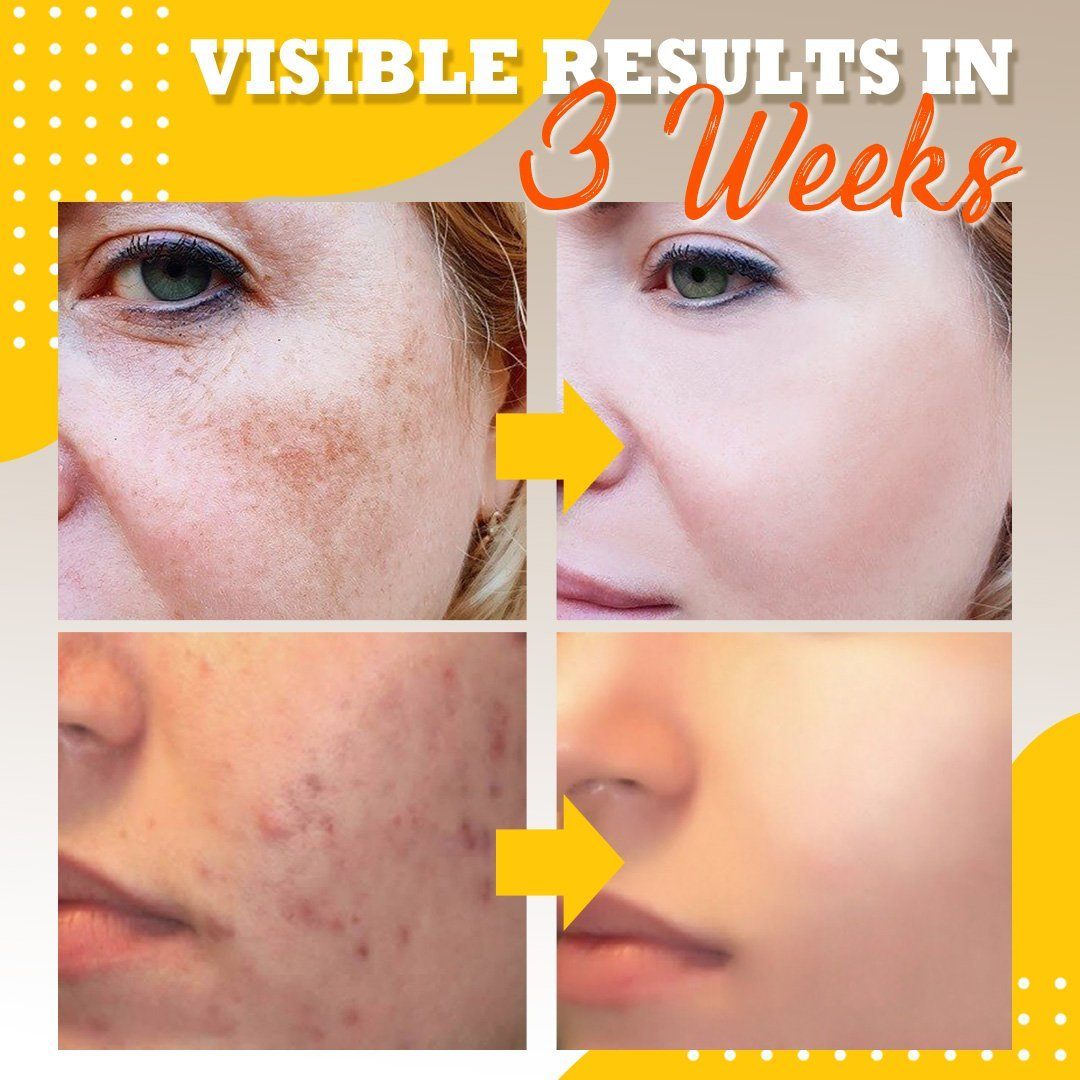 Instant Blemish Removal Gel