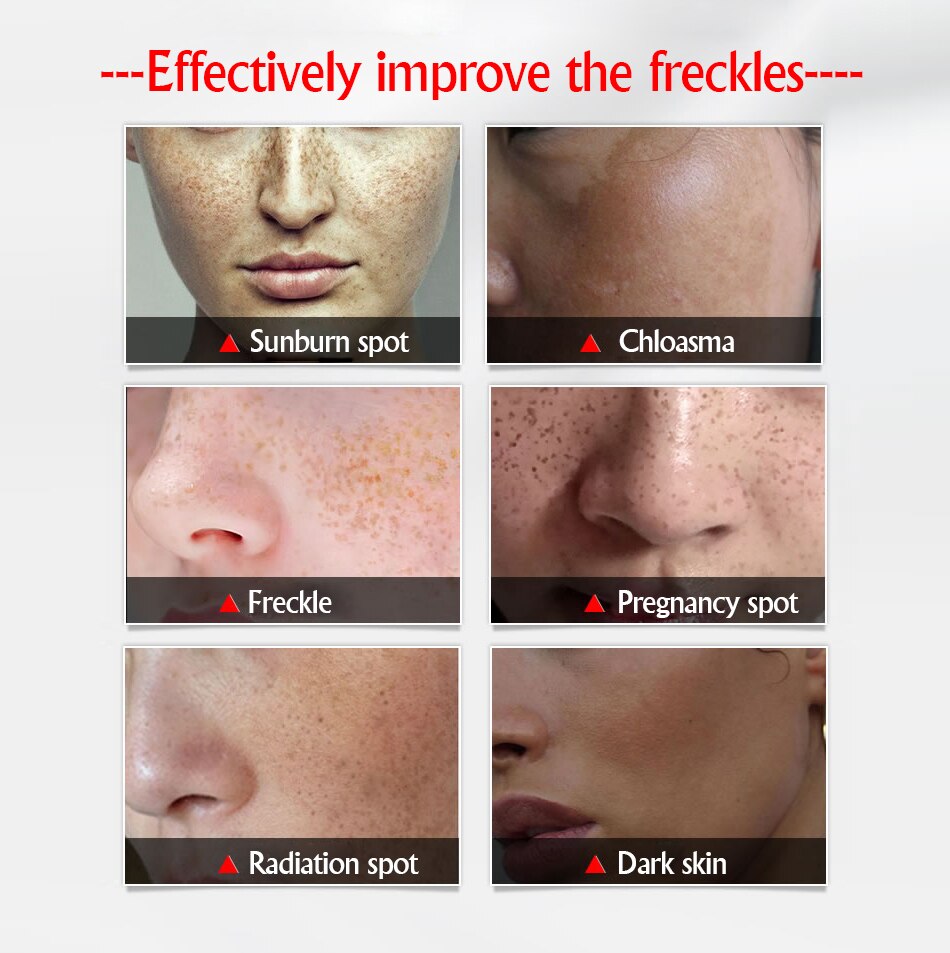 Freckles Removal Cream