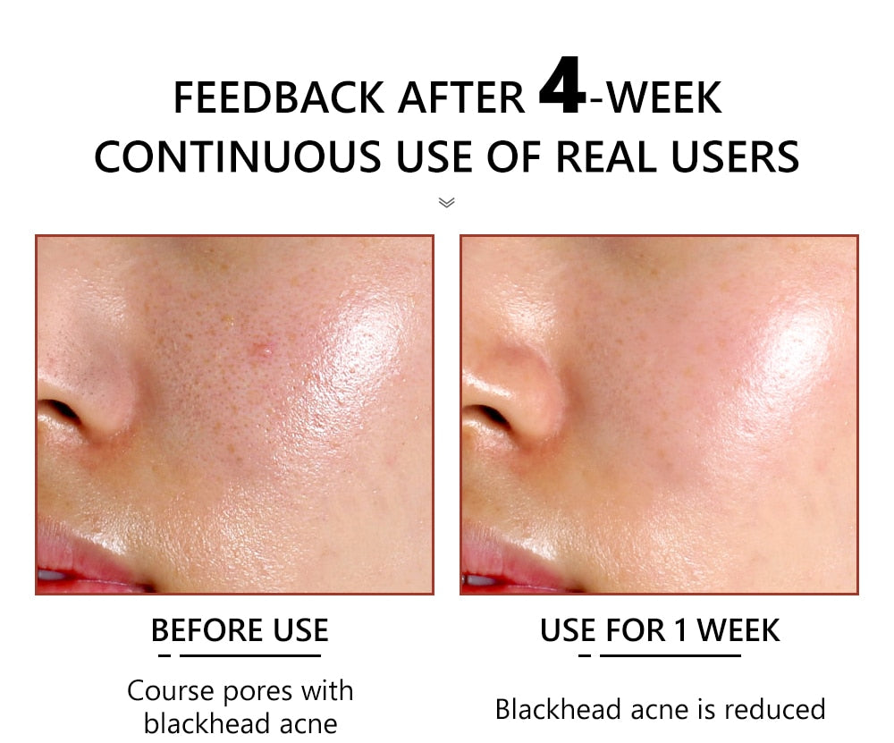 Pore Minimizer Serum (Salicylic Acid Serum)