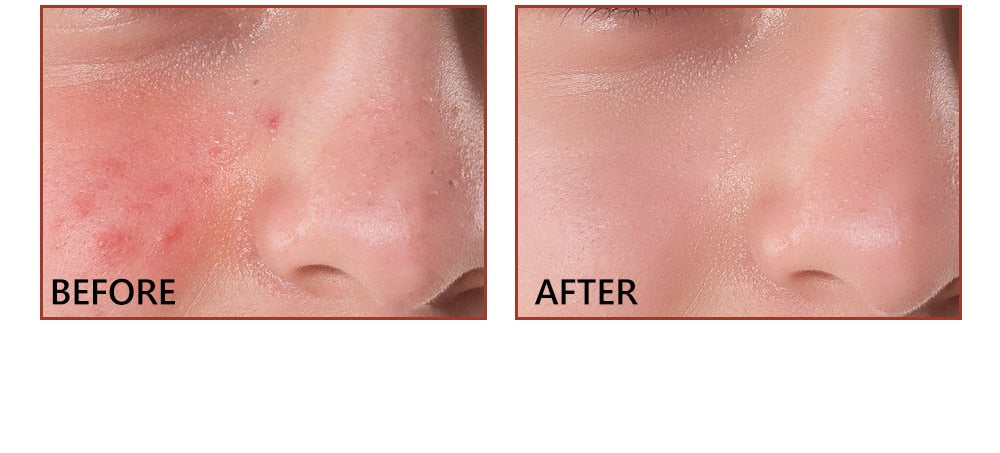 Pore Minimizer Serum (Salicylic Acid Serum)