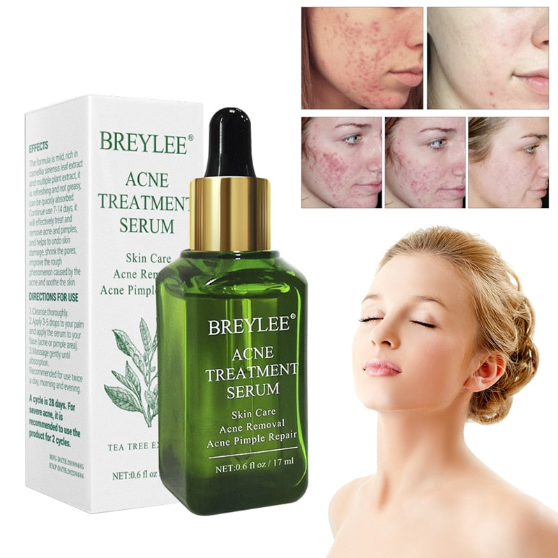 Acne Treatment Face Serum
