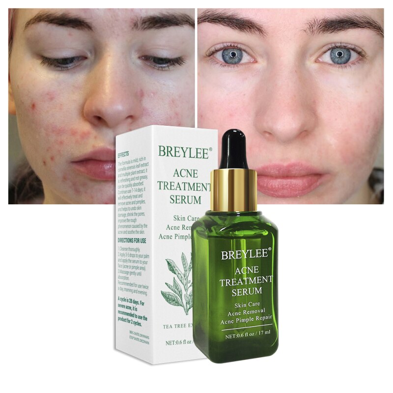 Acne Treatment Face Serum