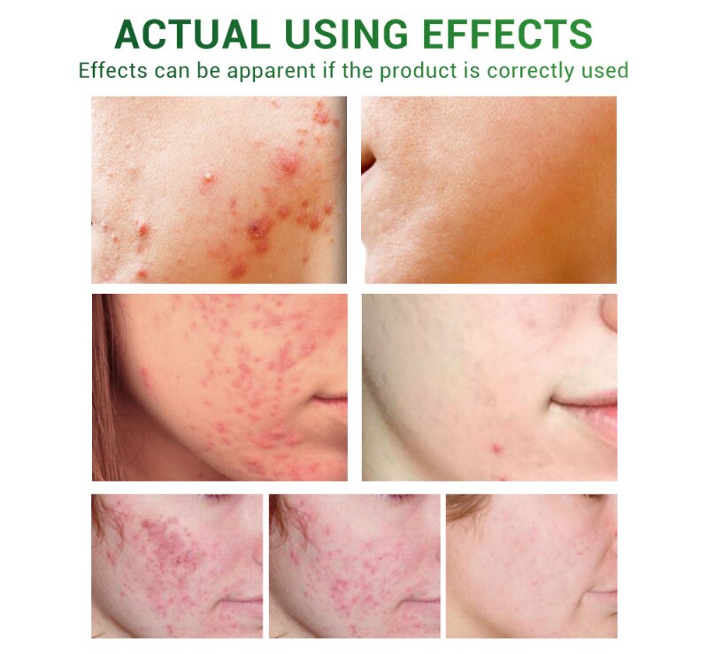 Acne Treatment Face Serum