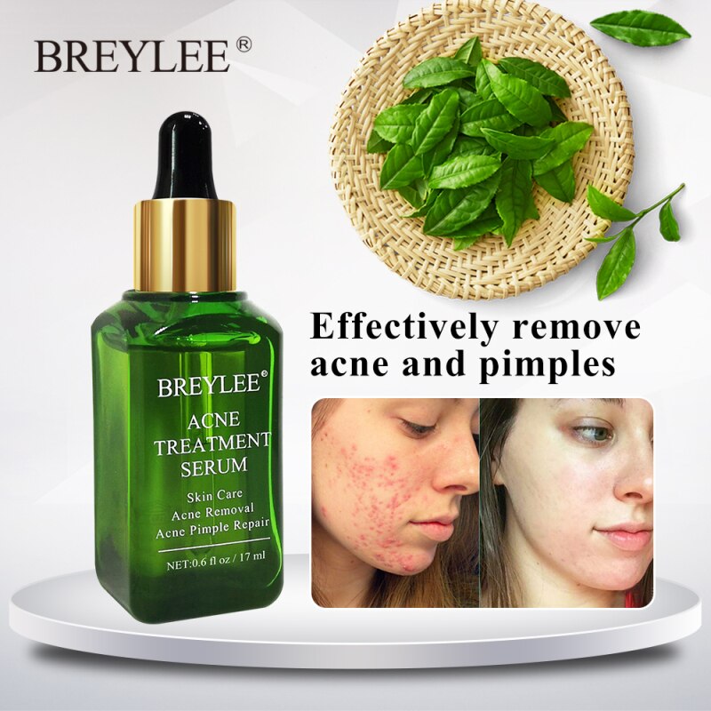 Acne Treatment Face Serum