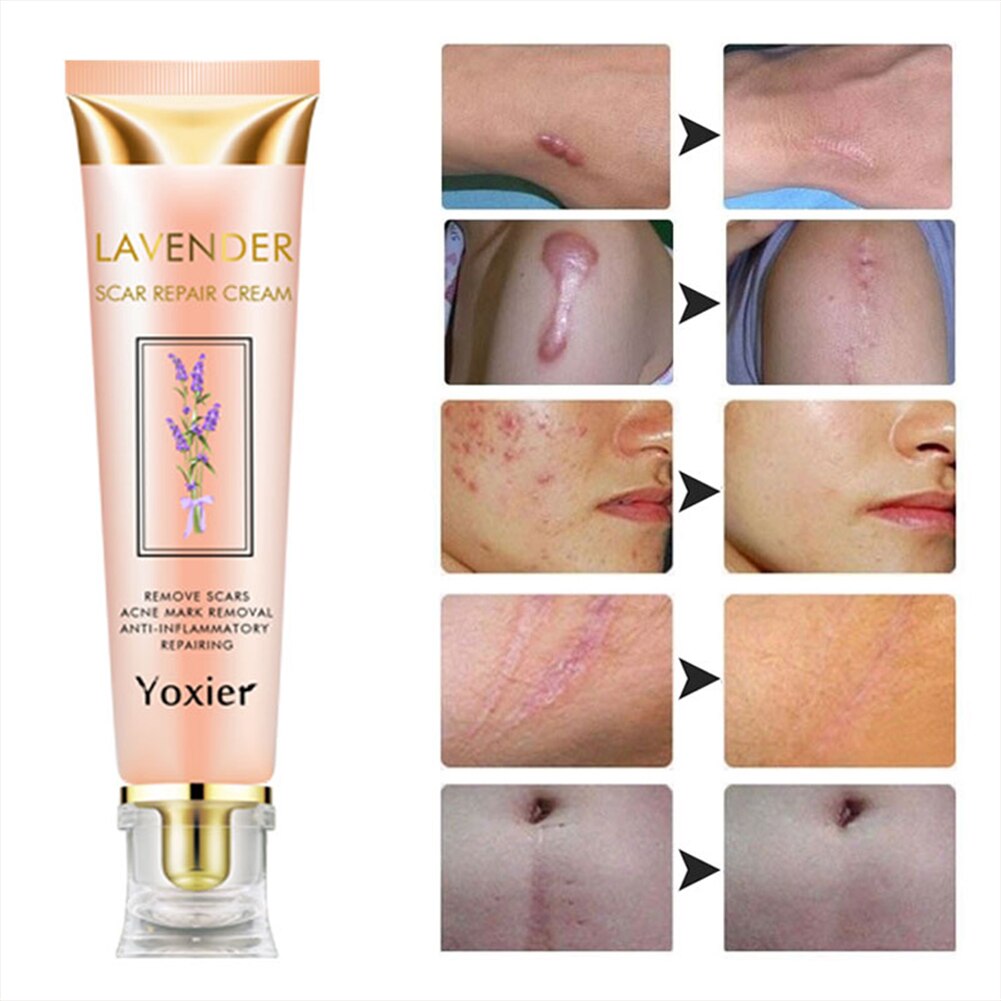 Scar Repair Removal Cream