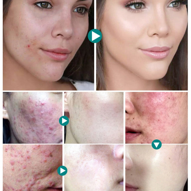 ClearAcne Ultimate Defense Gel