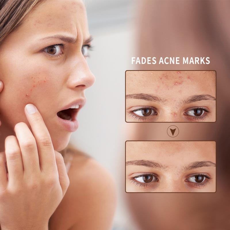 ClearAcne Ultimate Defense Gel