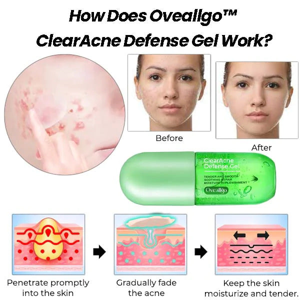 ClearAcne Ultimate Defense Gel