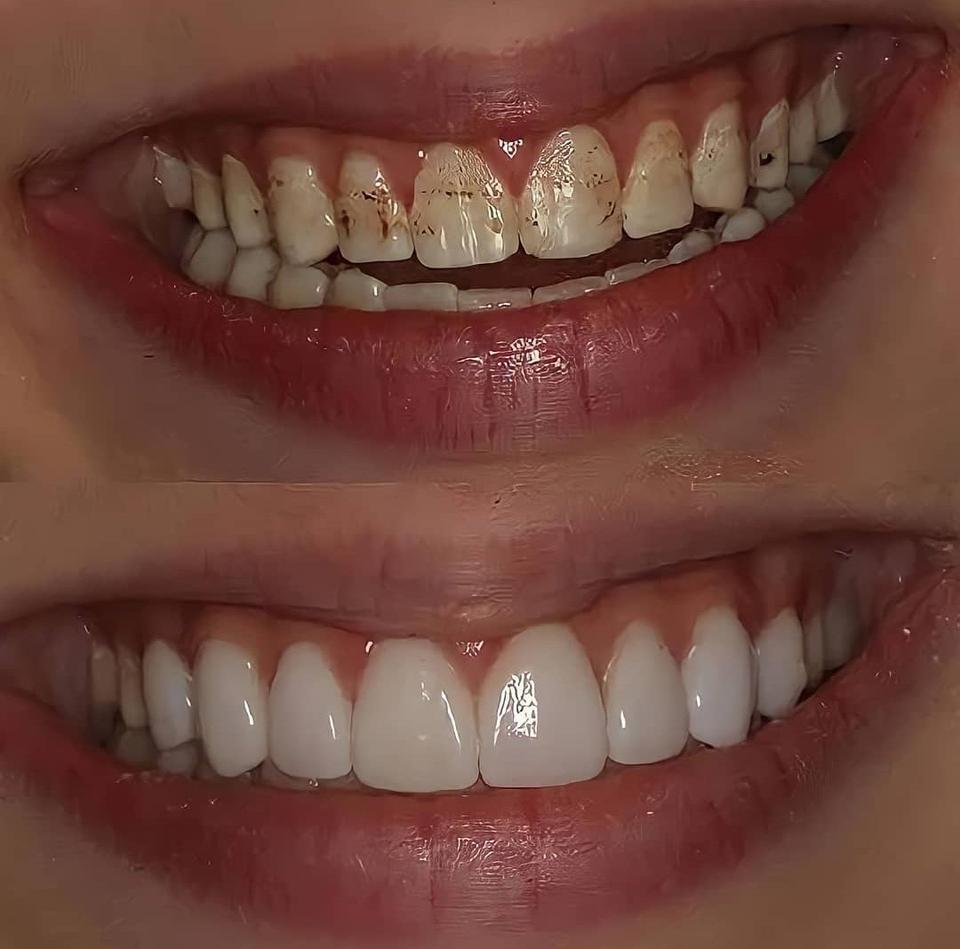 Charcoal Teeth Whitening