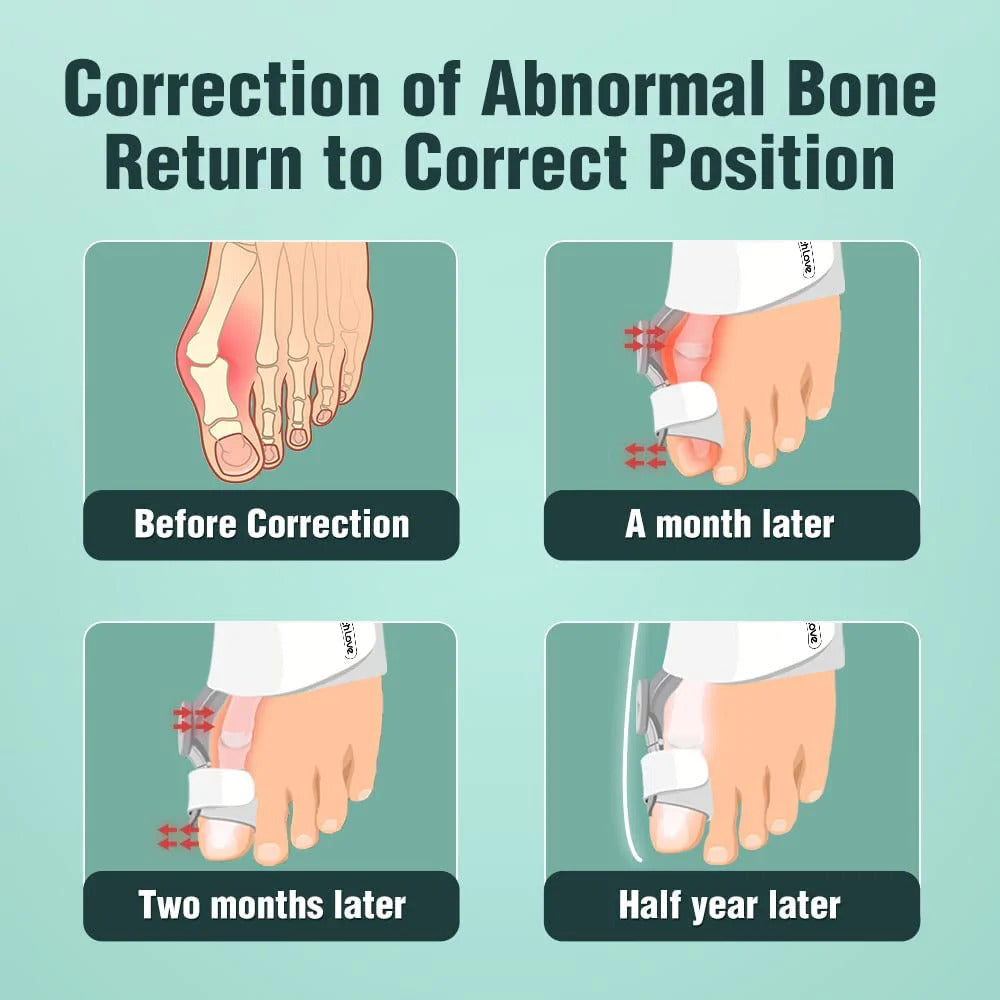 Flexible Bunion Corrector