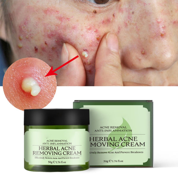 Acne Removing Cream