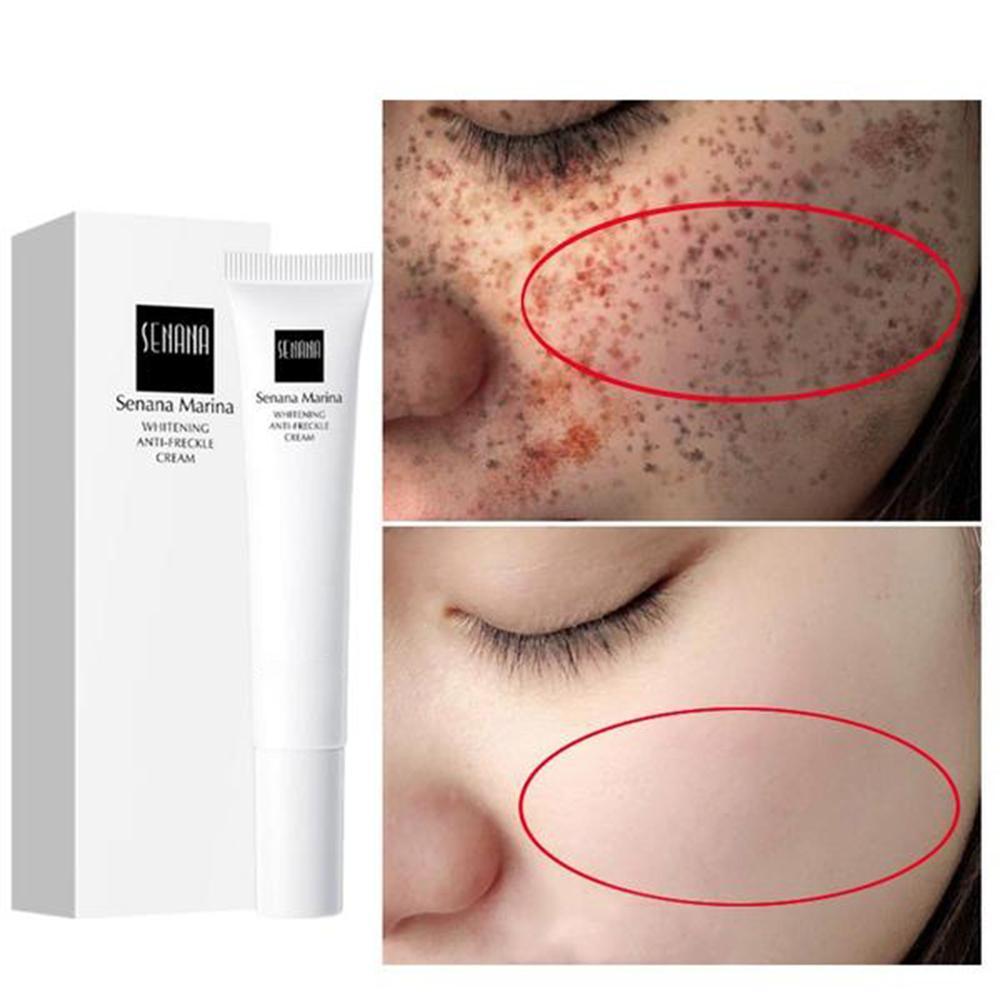 Freckles Removal Cream