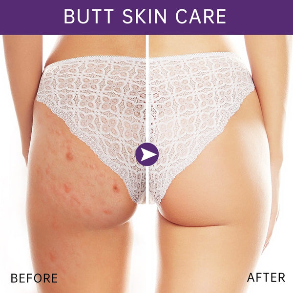 Butt Acne Treatment Cream