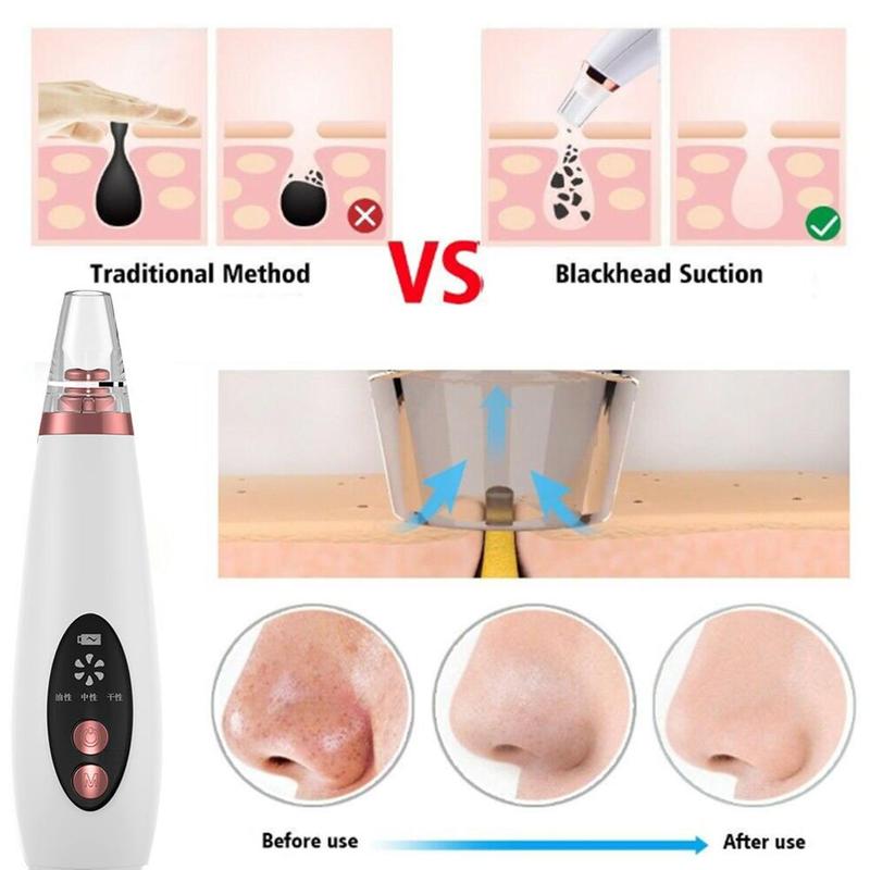 Vacuum Pore Cleaner and blackhead Remover