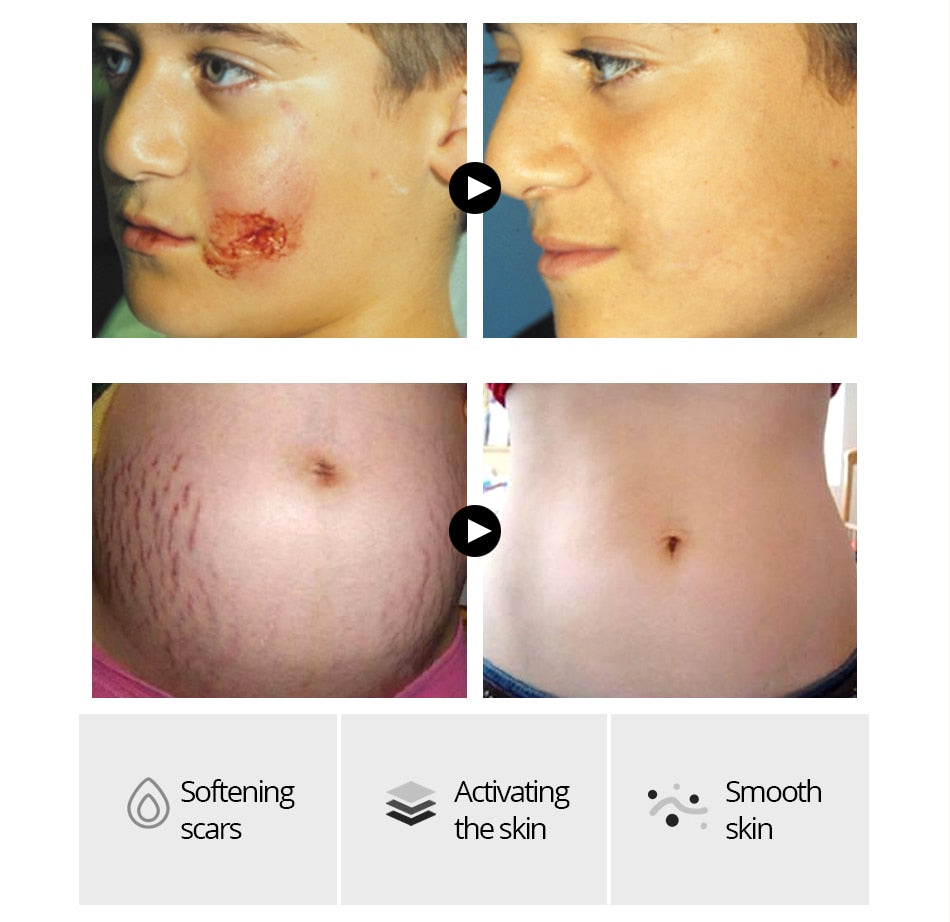 Acne Scar Removal Cream