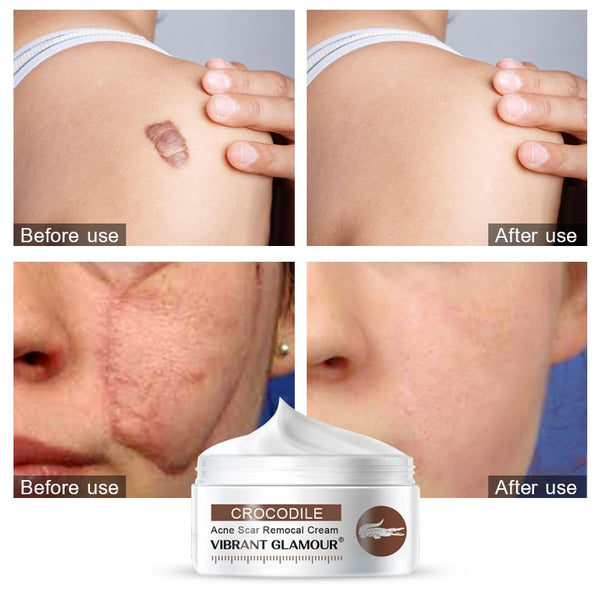 Acne Scar Removal Cream