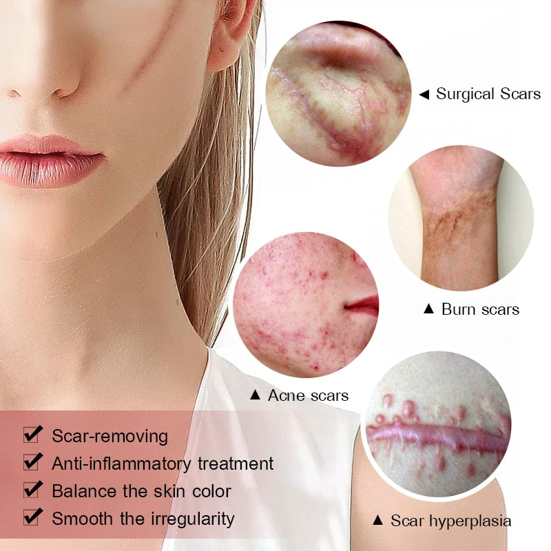Acne Scar Removal Cream