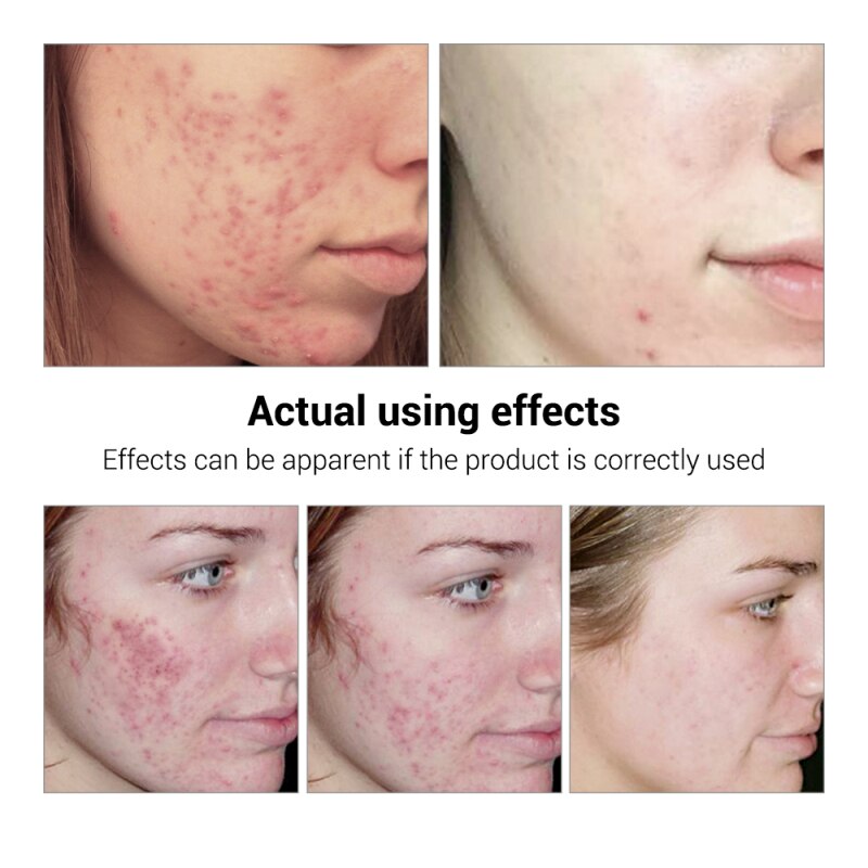 Acne Treatment Face Serum