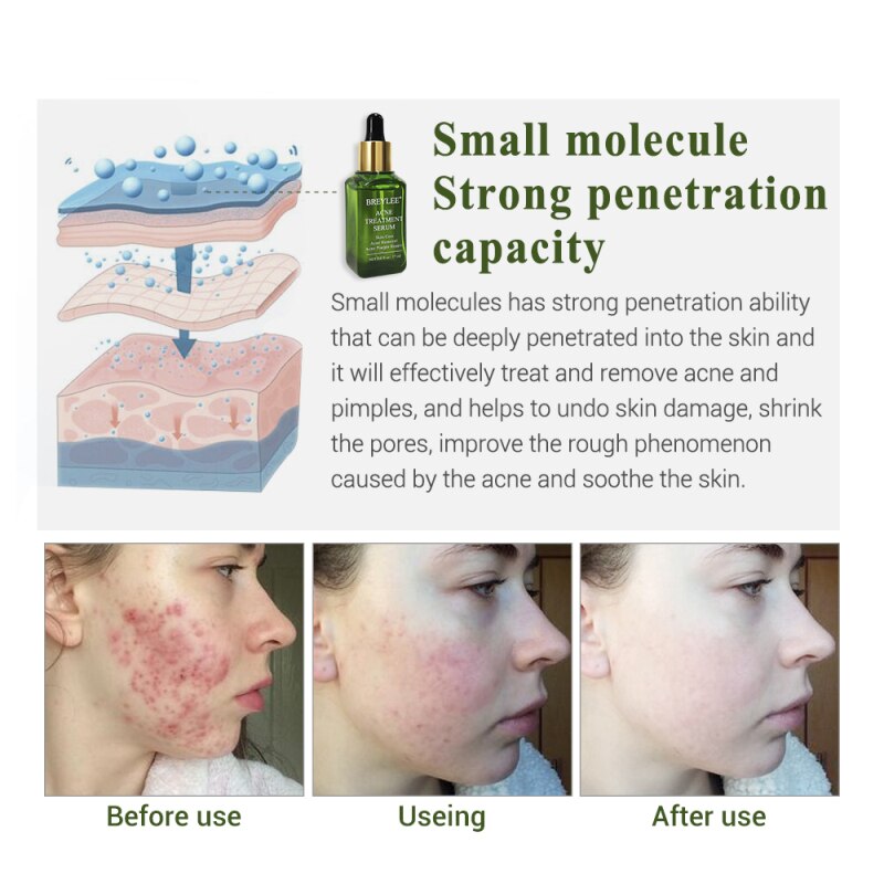 Acne Treatment Face Serum