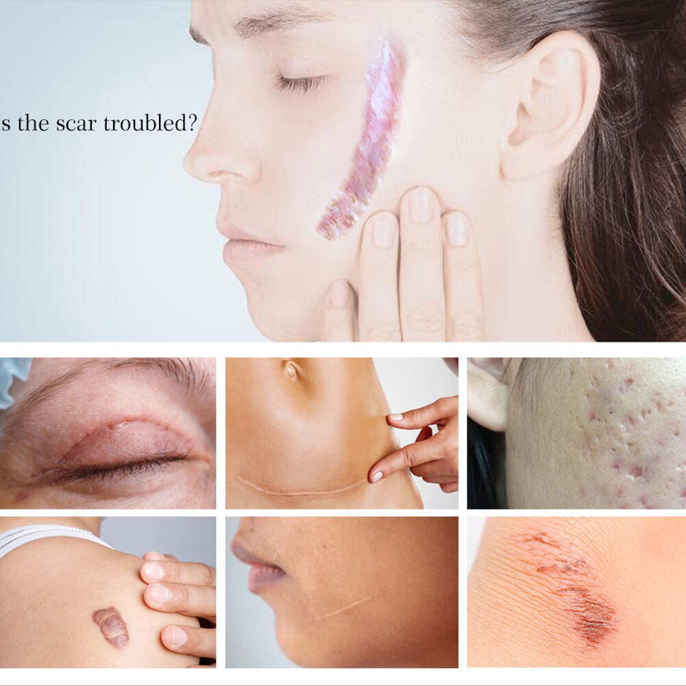 Scar Repair Removal Cream